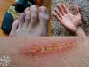 Collage von Kletterverletzungen an Fuss, Hand und Arm